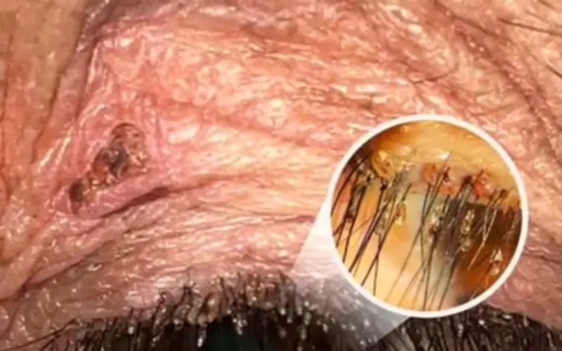 Ca bệnh hiếm: Rận mu ký sinh trên mí mắt người phụ nữ ở Nghệ An