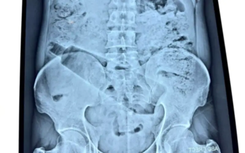 Ca phẫu thuật hiếm gặp: Lấy chai nhựa 1 lít từ trực tràng người đàn ông Ấn Độ