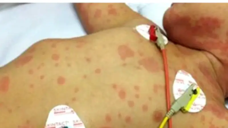 Cục Phòng bệnh cảnh báo nguy cơ viêm màng não mô cầu gia tăng trong mùa lễ hội 2026