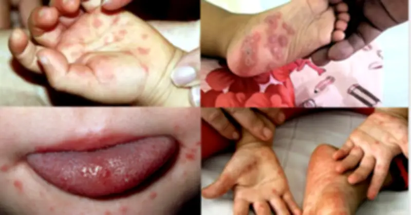 Cục Phòng bệnh cảnh báo sốt xuất huyết và tay chân miệng gia tăng, yêu cầu tăng cường phòng chống