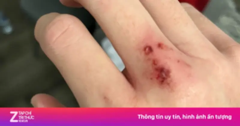 Chó Nghi Dại Cắn Liên Tiếp 6 Người Tại Đắk Lắk, Ngành Y Tế Khẩn Trương Xử Lý