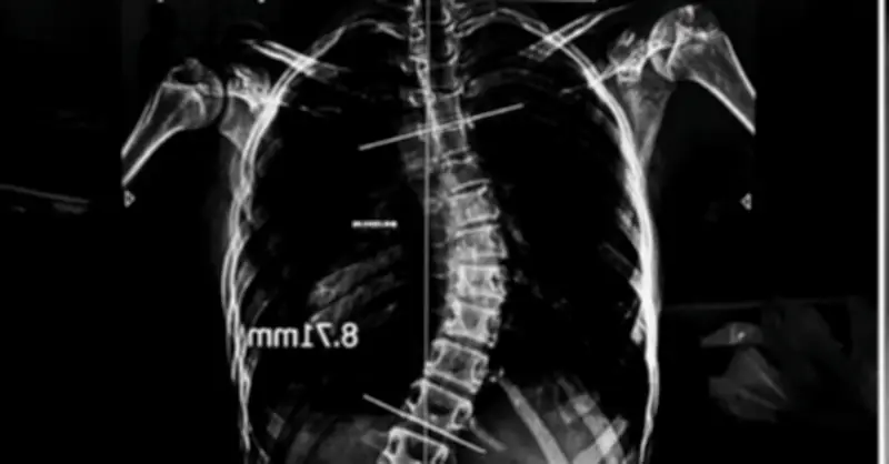 Cha mẹ chi tiền tỷ nắn chỉnh cột sống cong vẹo cho con