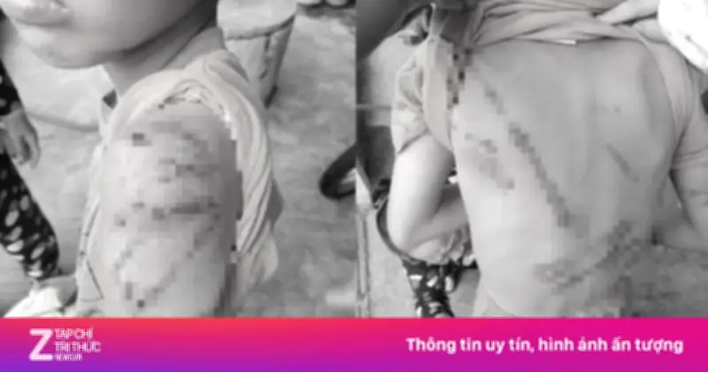 Cha ruột ở Đắk Lắk bị phạt 7,5 triệu đồng vì dùng roi mây đánh con trai 10 tuổi bầm tím