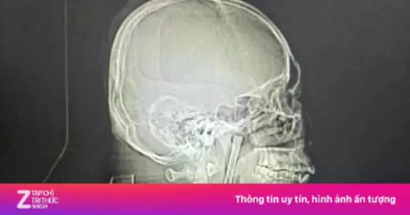 Chiếc đũa kim loại 12 cm mắc kẹt trong cổ họng người đàn ông suốt 8 năm