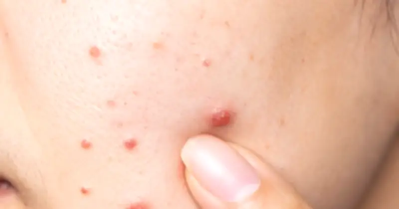 Chăm Sóc Da Sau Nặn Mụn: Bí Quyết Tránh Thâm Sẹo Và Phục Hồi Hiệu Quả