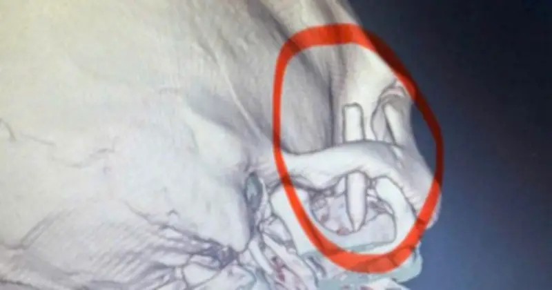 Chàng trai Quảng Ninh đau đầu 13 năm, bác sĩ gắp thành công dị vật bút bi trong thái dương