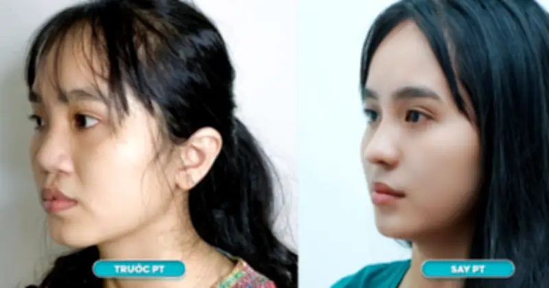 Chương trình thiện nguyện 'Vì sống là sẻ chia' hỗ trợ 4 tỷ đồng cho phẫu thuật dị tật mũi môi năm 2026