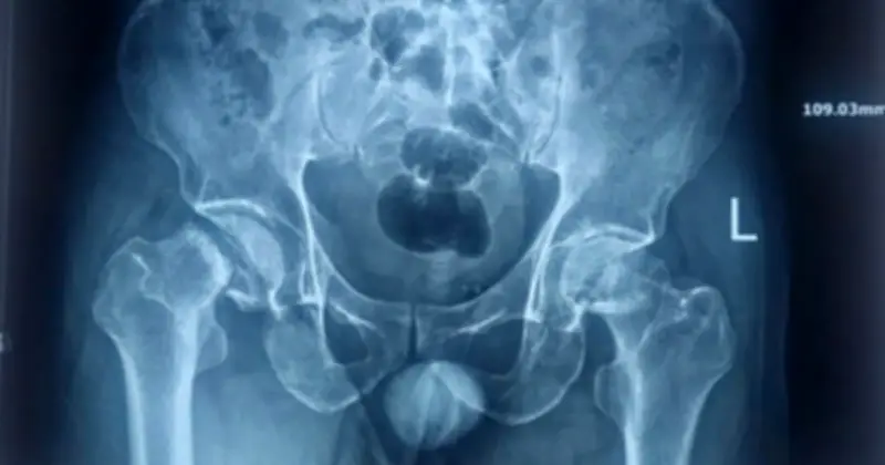 Cần Thơ: Thành công ca phẫu thuật thay khớp háng 2 bên bằng kỹ thuật ít xâm lấn