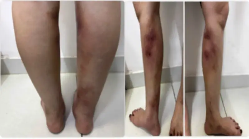 Cảnh báo biến chứng nguy hiểm từ tiêm filler làm thẳng chân tại nhà