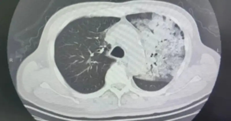Cảnh báo: Điều hòa không vệ sinh gây viêm phổi nặng do vi khuẩn Legionella