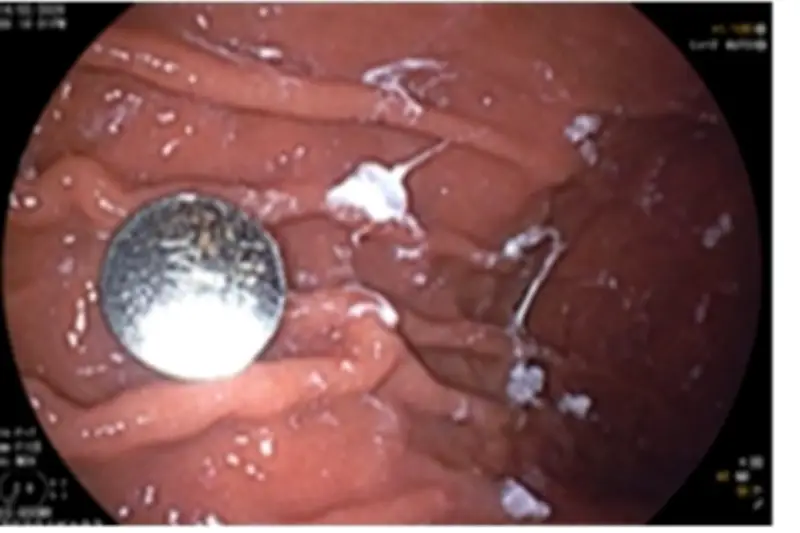 Cảnh báo nguy hiểm từ dị vật: Xương gà găm thực quản, trẻ nuốt pin cúc áo