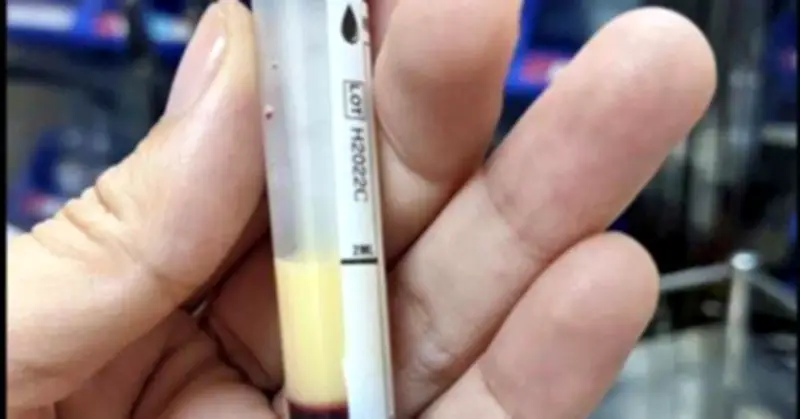 Cảnh báo sau Tết: Mỡ máu tăng cao, nhiều người trẻ cấp cứu vì viêm tụy cấp