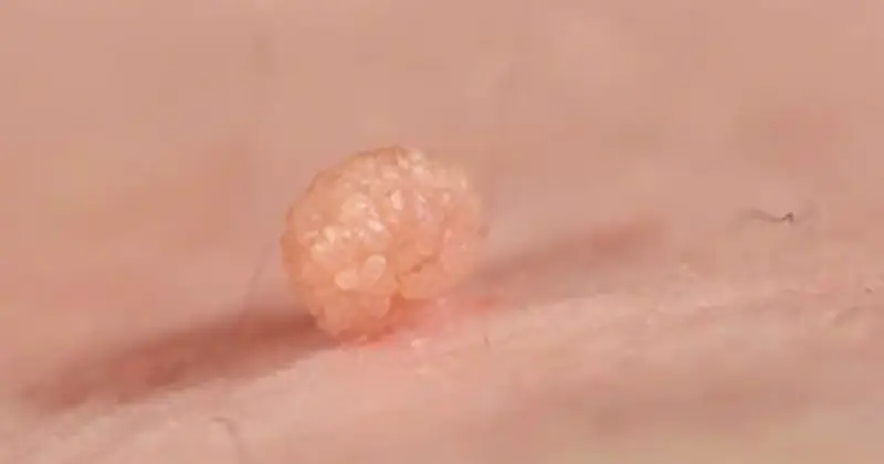 Cảnh báo từ Bệnh viện Da liễu T.Ư: Tự điều trị sùi mào gà tại nhà khiến bệnh lan rộng