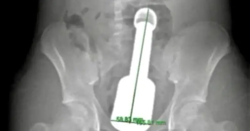 Cảnh báo từ ca cấp cứu dị vật hậu môn: Khoảng trống giáo dục giới tính tuổi dậy thì