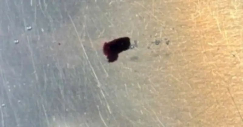 Cứu thành công tinh hoàn bệnh nhân bị mảnh kim loại bắn xuyên qua phẫu thuật khẩn