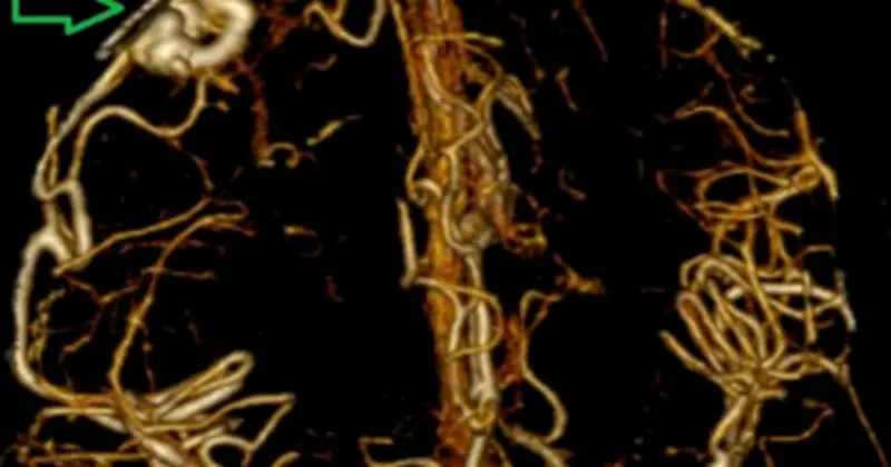 Dị dạng mạch máu não ở người trẻ: Xu hướng gia tăng đáng báo động