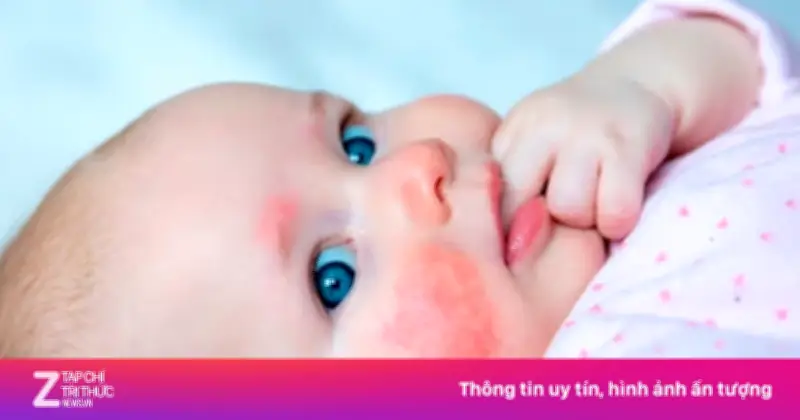 Dị Ứng Đạm Sữa Bò Ở Trẻ: Dấu Hiệu, Nguyên Nhân Và Cách Xử Lý