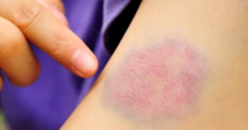 Da Vàng, Ngứa, Dễ Bầm Tím: Cảnh Báo Sớm Bệnh Gan Qua Dấu Hiệu Trên Da