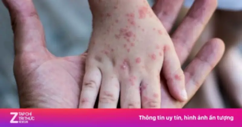 Dịch tay chân miệng bùng phát mạnh tại miền Nam, cảnh báo khẩn về chủng EV71 nguy hiểm