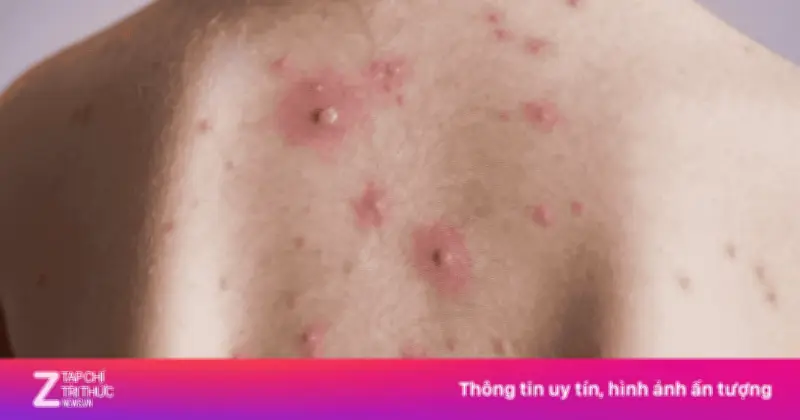 Ổ Dịch Thủy Đậu Bùng Phát, Đại Học Thái Lan Chuyển Toàn Bộ Lớp Học Sang Trực Tuyến