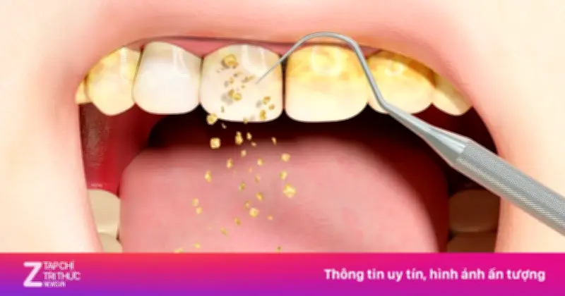 Dấu Hiệu Cảnh Báo Đến Lúc Cần Lấy Cao Răng Để Bảo Vệ Sức Khỏe Răng Miệng