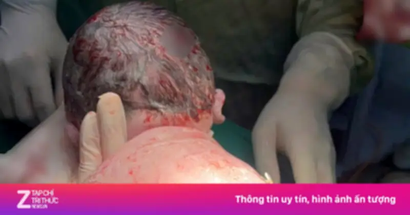 Em bé chào đời với 'đôi cánh' shunt trên lưng, vượt qua tràn dịch màng phổi nguy kịch