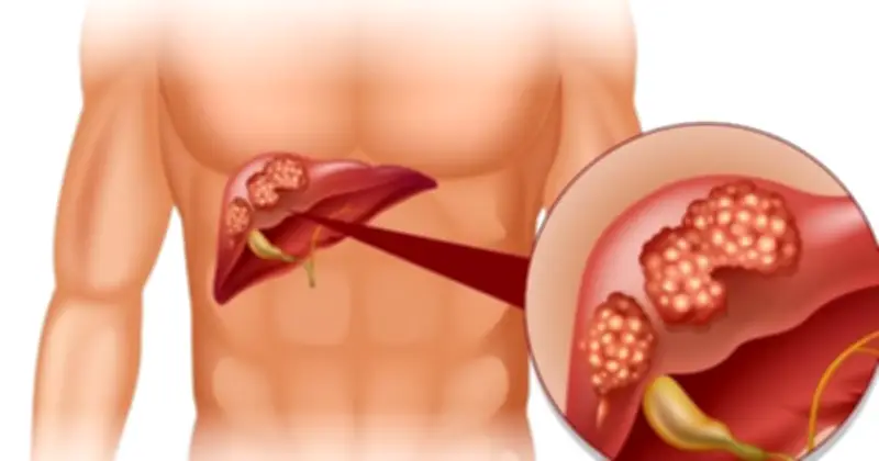 Gan dễ tổn thương, aflatoxin trong thực phẩm mốc là mối nguy ung thư gan