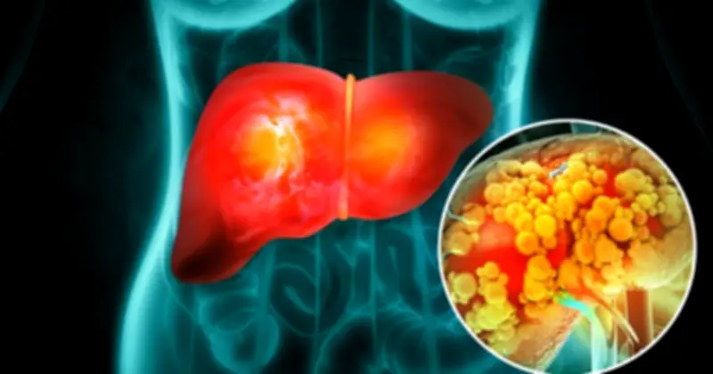 Gan Nhiễm Mỡ Không Do Rượu: Đường Fructose Là 'Kẻ Thù Số Một' Của Gan