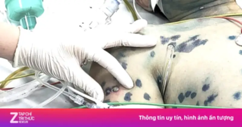 Hệ miễn dịch 'vỡ trận', người đàn ông 39 tuổi đối mặt tử thần sau ca mổ tắc ruột