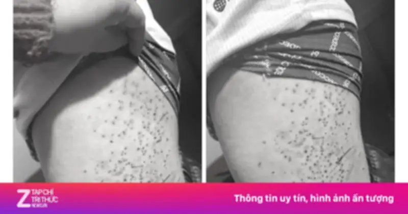 Học sinh lớp 7 bị bạn dùng bút bi đâm chi chít vào đùi do tranh chấp chỗ ngồi