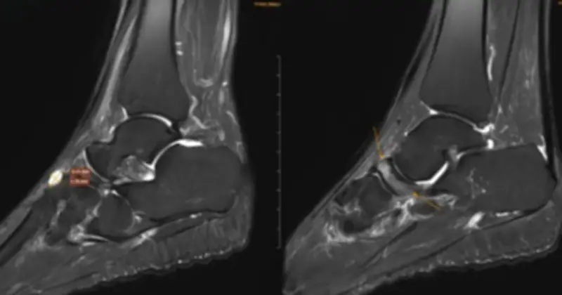 Hội chứng Mueller-Weiss hiếm gặp: Cảnh báo từ ca bệnh nữ giáo viên 52 tuổi