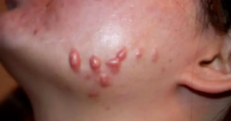 Hiểu Cơ Chế Sinh Học Để Mờ Sẹo Lồi Do Mụn Hiệu Quả