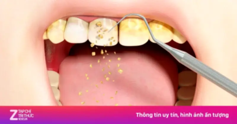 Hậu quả khôn lường khi bỏ qua việc lấy cao răng định kỳ
