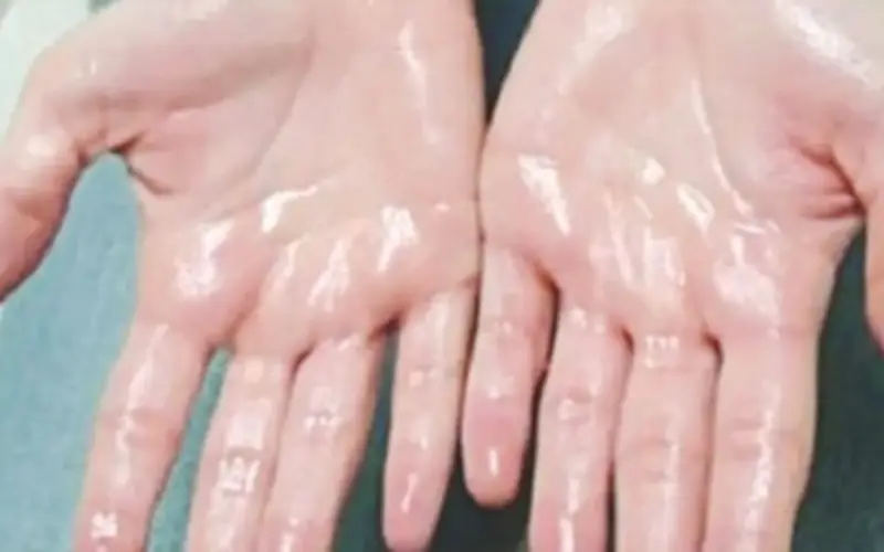 Khắc Phục Mồ Hôi Tay: 9 Phương Pháp Đơn Giản Từ Thiên Nhiên Đến Hiện Đại