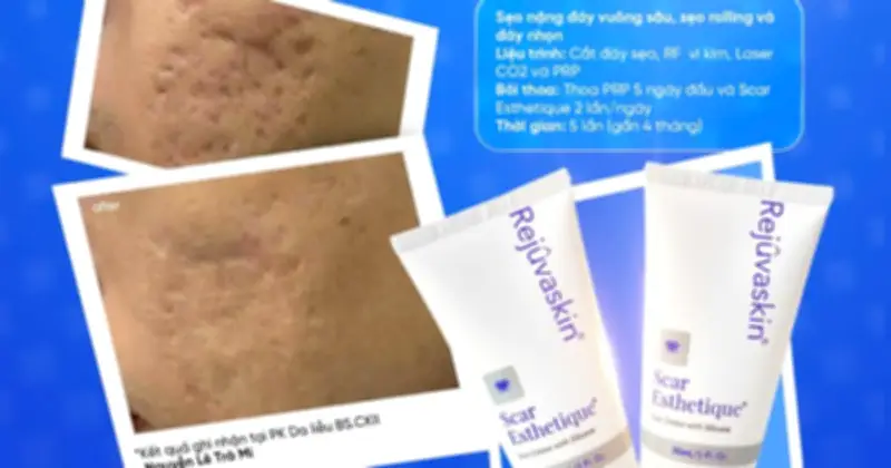 Laser trị sẹo mụn: Phục hồi đúng cách mới quyết định hiệu quả bền vững