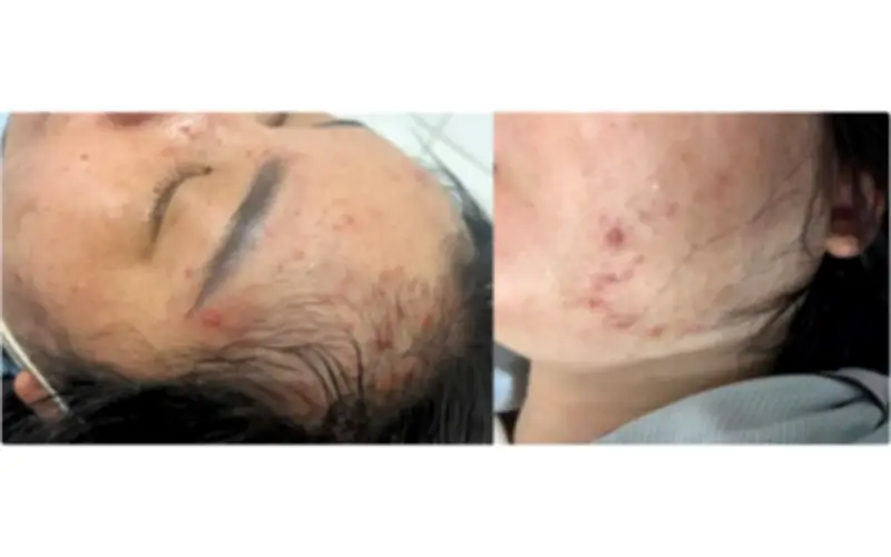 Mắc bệnh thủy đậu khi mang thai: Thai phụ đối mặt với những nguy cơ nào?