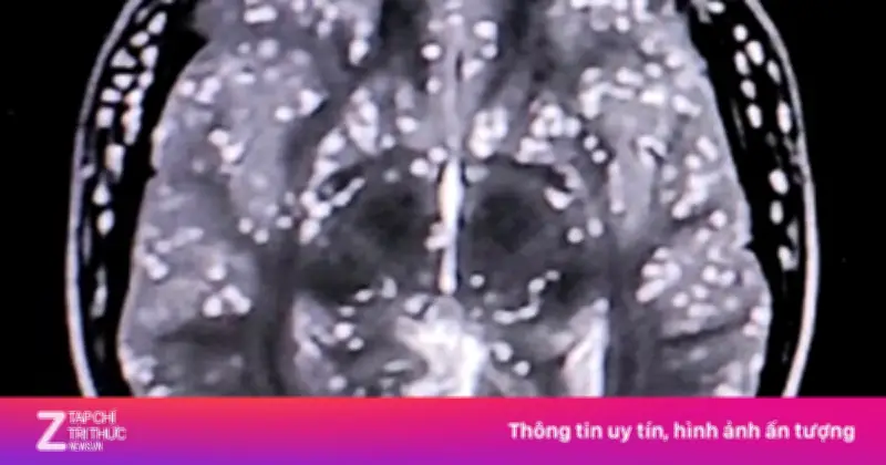 Món khoái khẩu tiết canh khiến sán dây lợn làm tổ trong não người đàn ông