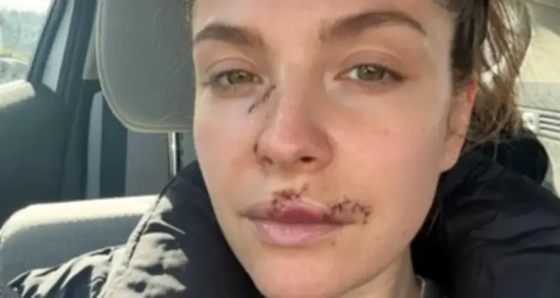 Nữ diễn viên 37 tuổi lộ gương mặt đầy vết thương sau vụ bị chó cắn