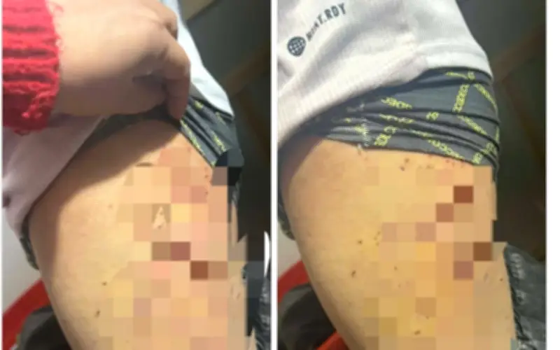 Nữ sinh lớp 7 bị bạn dùng bút bi đâm chi chít vào đùi, gia đình tố cáo