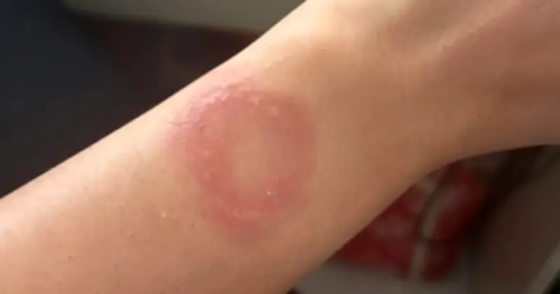 Người dùng Apple Watch bị bỏng nặng, vật lộn 6 tháng không được hỗ trợ