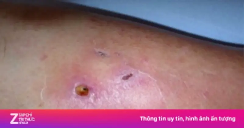 Người đàn ông 30 tuổi thoát chết nhờ phát hiện sớm vi khuẩn ăn thịt người từ vết thương nhỏ