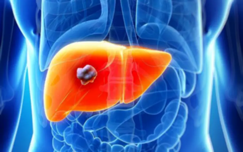 Người đàn ông 44 tuổi phát hiện ung thư gan sau xét nghiệm men gan tăng cao