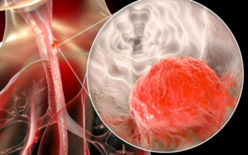 Người đàn ông mắc ung thư thực quản cảnh báo 2 sai lầm nhiều người Việt mắc phải