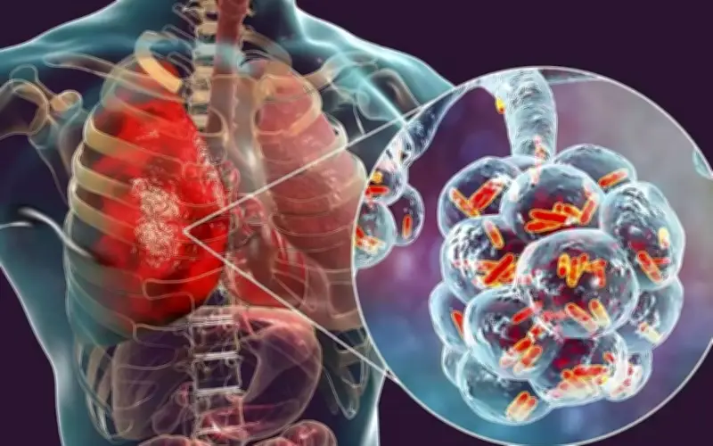 Người đàn ông phát hiện ung thư phổi di căn từ dấu hiệu nhiều người Việt bỏ qua