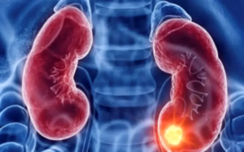 Người đàn ông phát hiện ung thư thận từ dấu hiệu nhiều người Việt thường bỏ qua