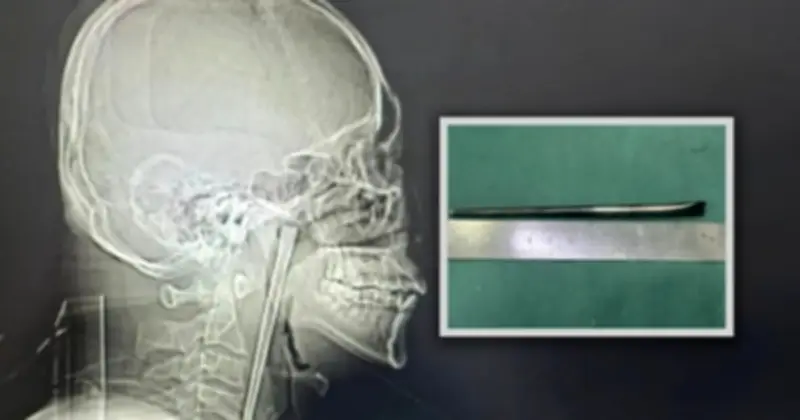 Người đàn ông sống 8 năm với chiếc đũa 12 cm trong cổ họng vì sợ phẫu thuật