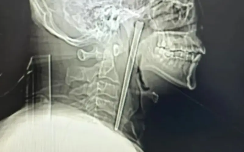 Người đàn ông sống chung với chiếc đũa kim loại trong cổ họng suốt 8 năm