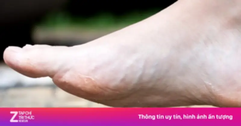 Người đàn ông suýt mất mạng vì chủ quan với vết đinh đâm ở chân