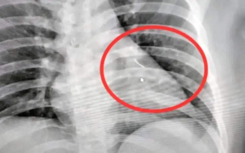 Người đàn ông Thái Lan nhập viện khẩn cấp sau khi kim khâu 7 cm đâm vào ngực