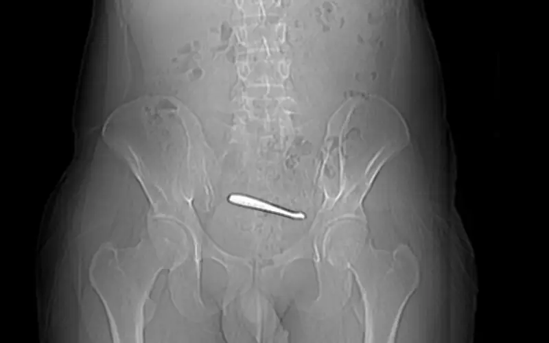 Người đàn ông Trung Quốc nuốt hai chiếc thìa, bác sĩ cảnh báo nguy cơ thủng ruột